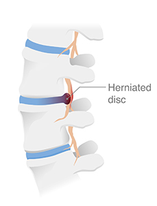 disc injury treatment in st pete