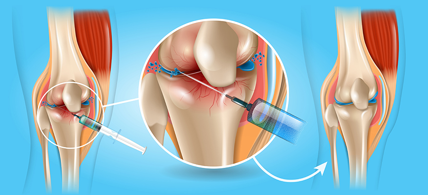 knee injections in st pete
