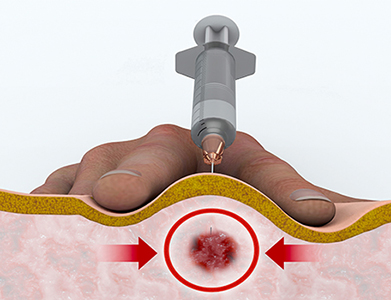 trigger point therapy in st petersburg